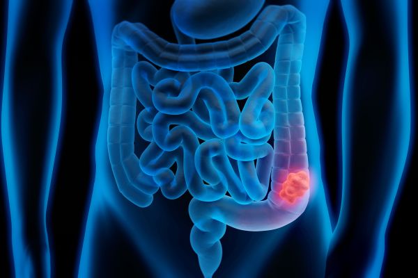 Colon cancer tumor 